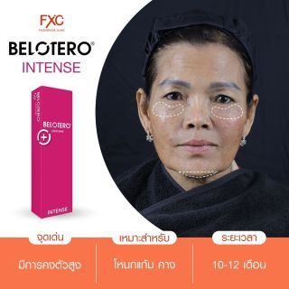 Filler Belotero Volume 1 cc เลือก 1 ตำแหน่ง ร่องแก้ม,แก้ม