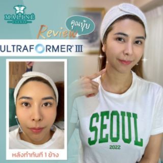 Maline Clinic อัลตร้าฟอร์มเมอร์ 3 (400 ช็อต) + โบท็อกซ์ ลิฟติ้ง กรอบหน้า