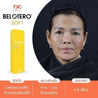 Filler Belotero Soft 1 cc เลือก 1 ตำแหน่ง ร่องลึกใต้ตา,Fine line (เคสรีวิว)